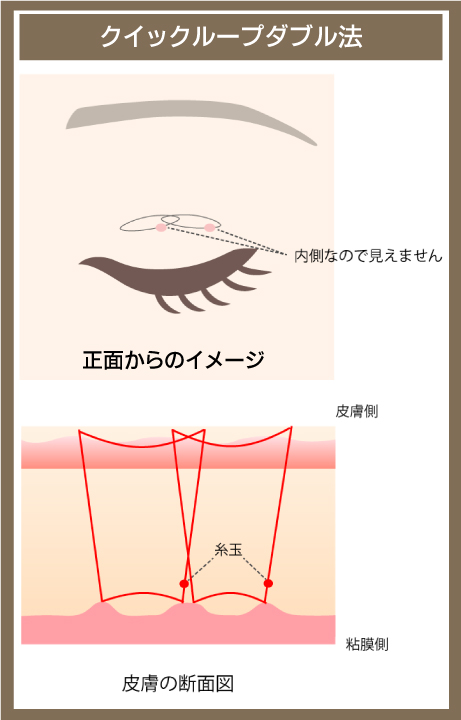クイックループダブル法の図解