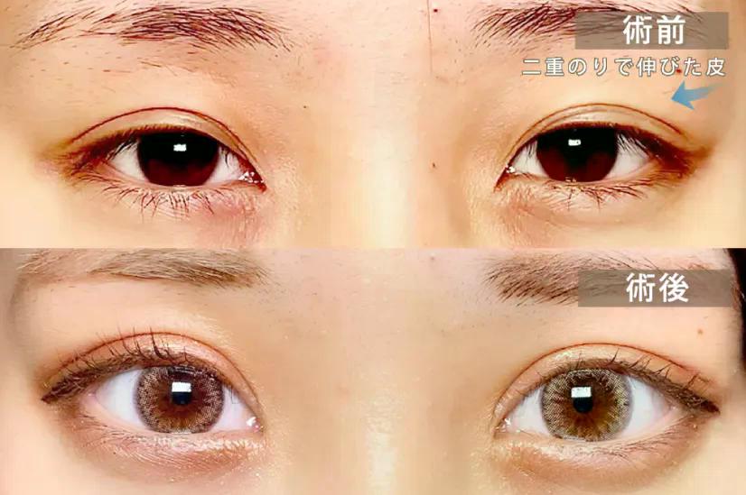 たるみ取り併用全切開の術前と術後の症例写真
