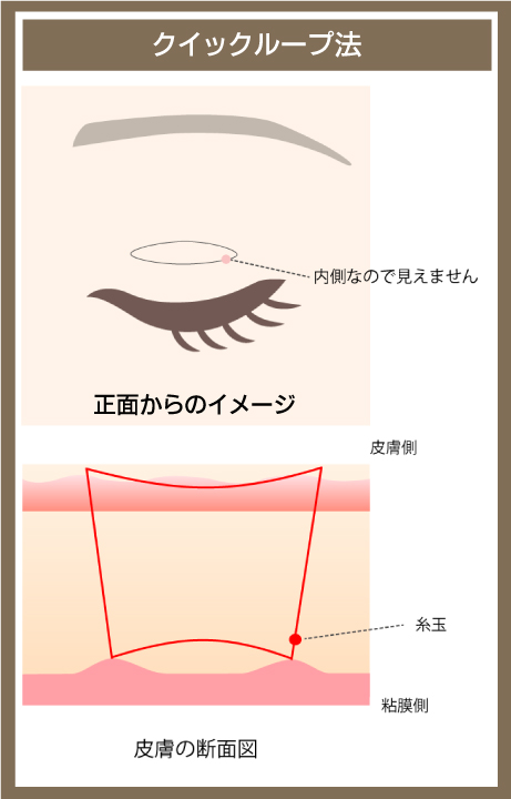 クイックループ法の図解