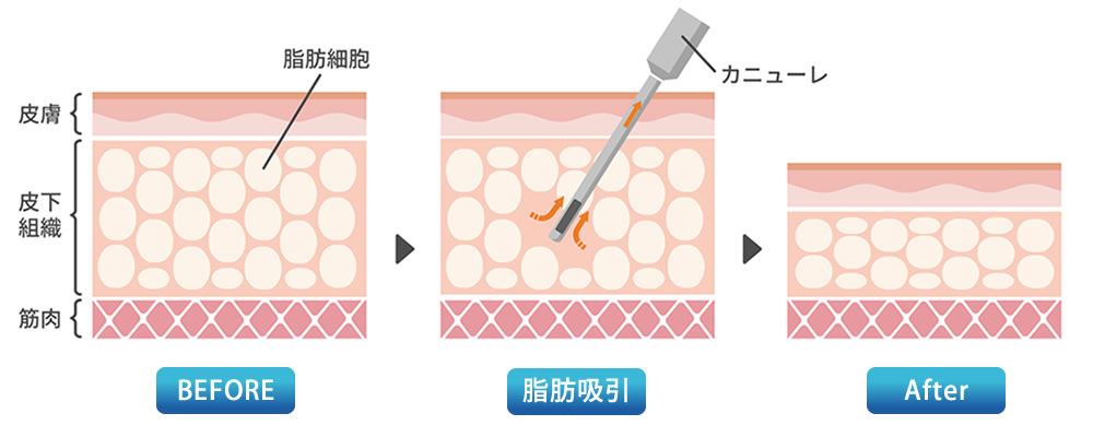 脂肪吸引の解説