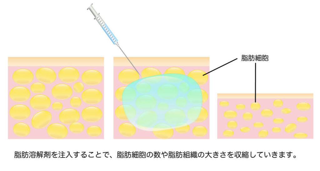 脂肪溶解注射のイメージ