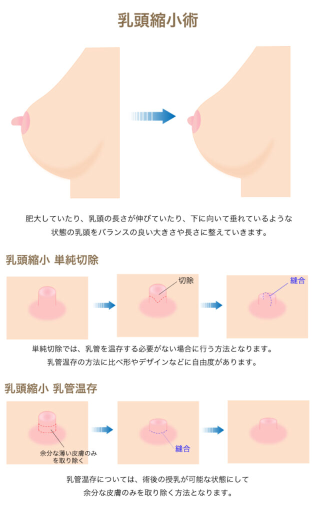 乳頭縮小の図解