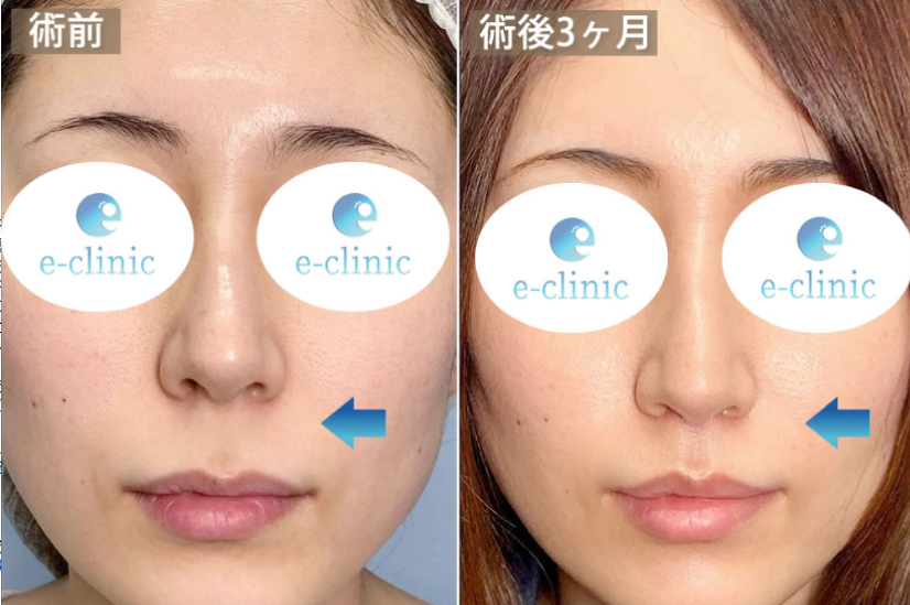 人中短縮の症例写真