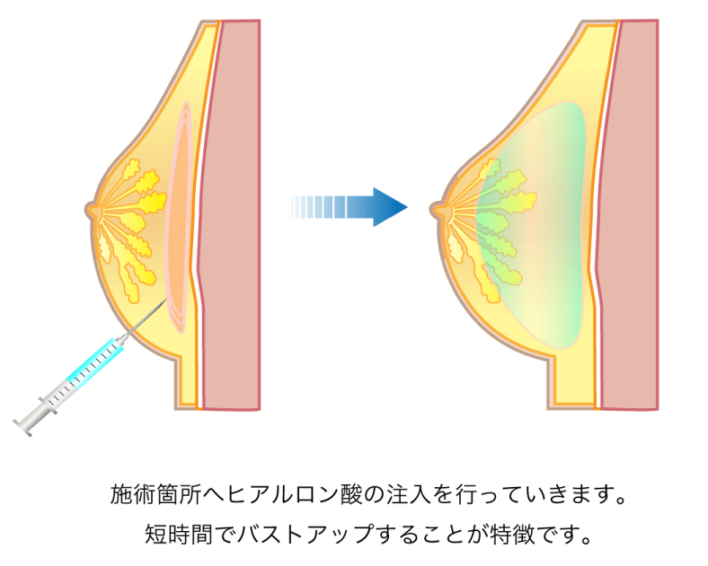 ヒアルロン酸豊胸の図解