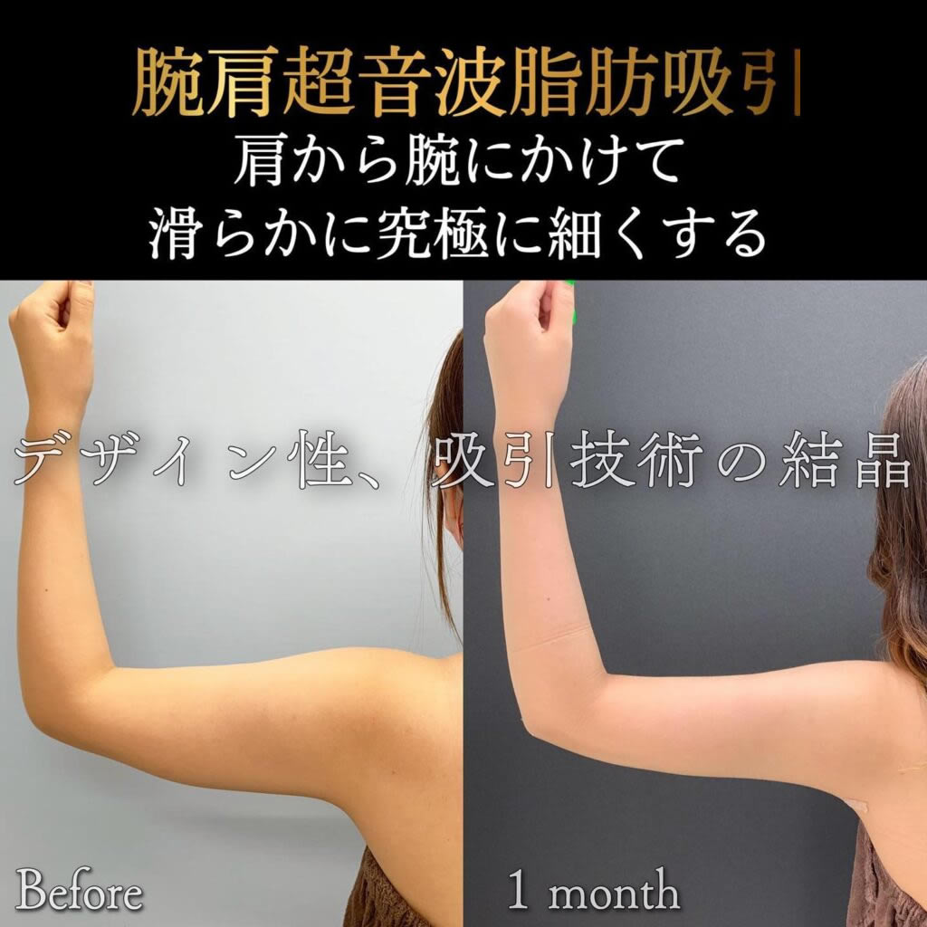 二の腕の脂肪吸引の症例写真