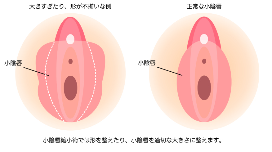 縮小の手術が必要の説明画像