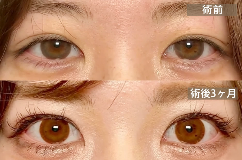 腱膜性眼瞼下垂(眠たそうな目)の症例写真