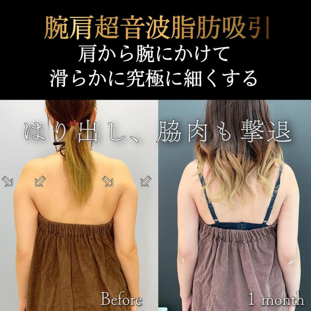 腕肩の超音波脂肪吸引の症例写真