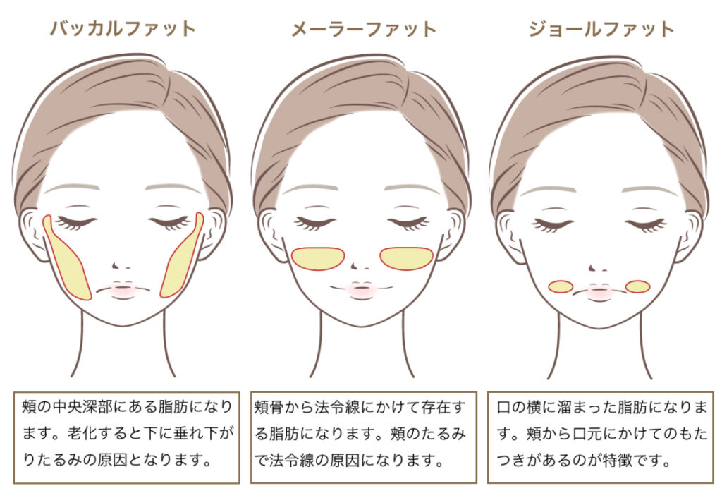 頬や口周りに存在する脂肪についての画像