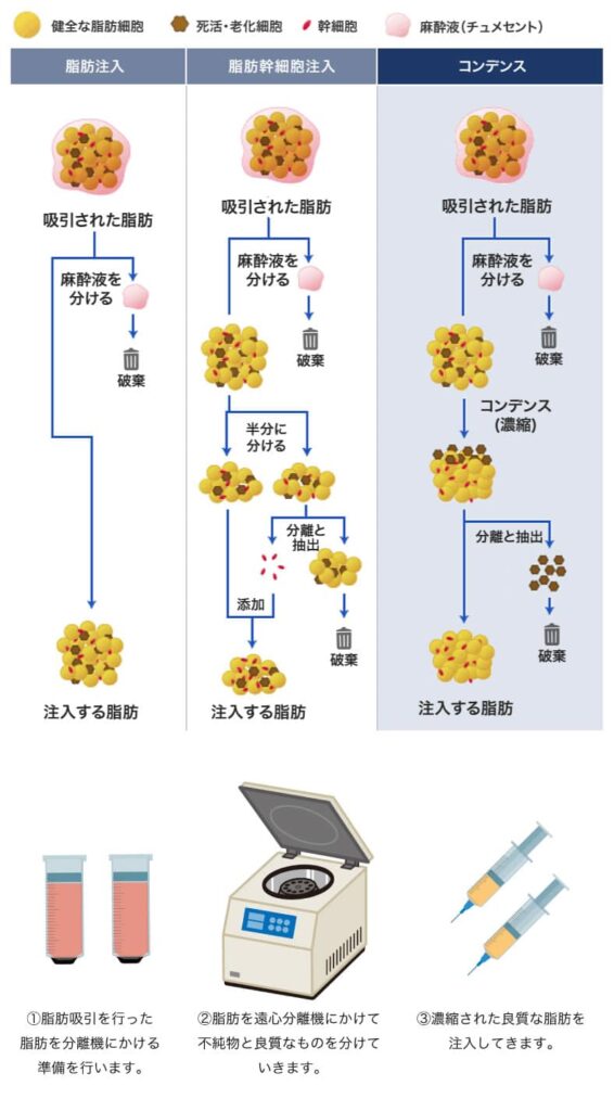 脂肪注入の脂肪分解の図解