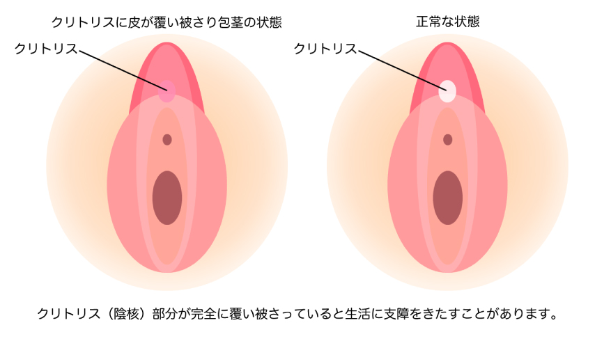 クリトリス（陰核）包茎を説明する画像