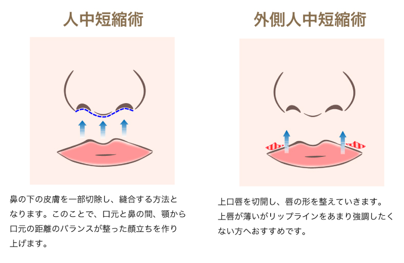 人中短縮術(リップリフト)説明画像
