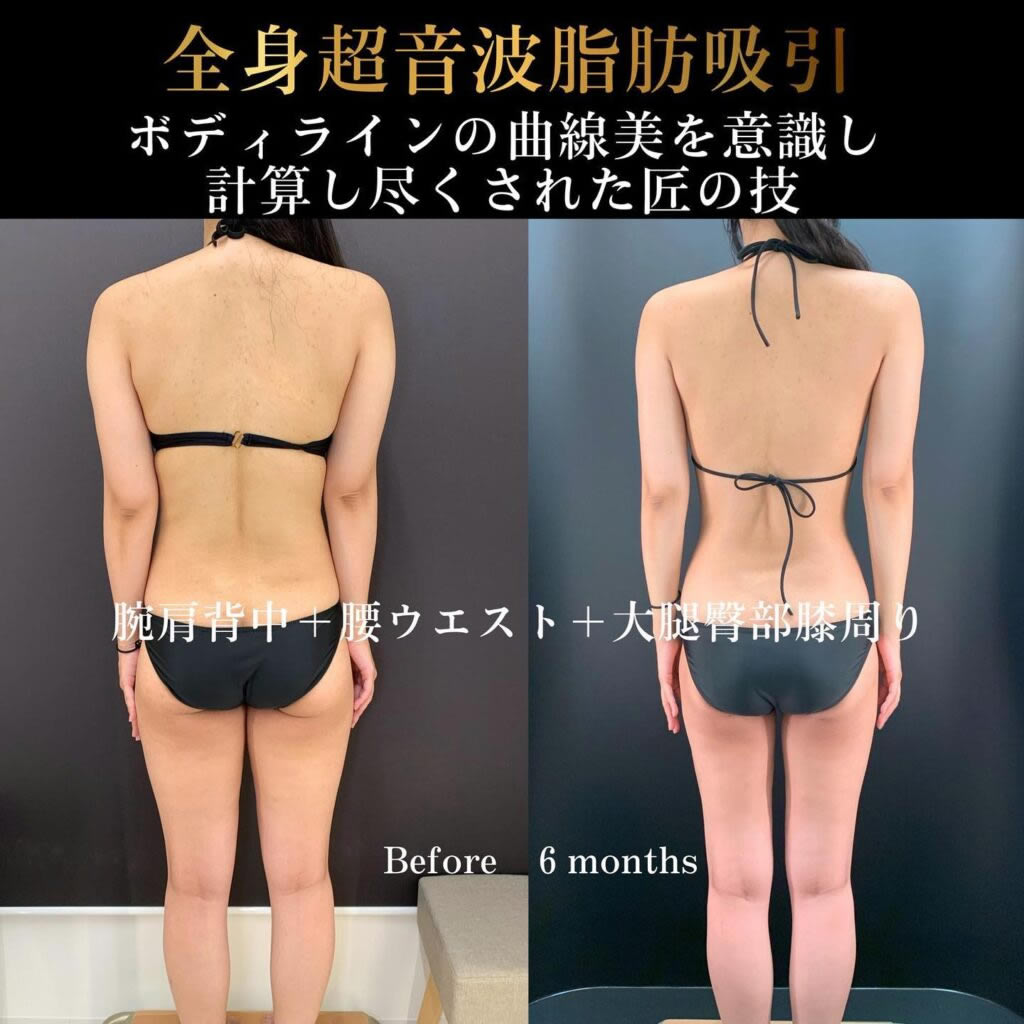 全身の脂肪吸引の症例写真