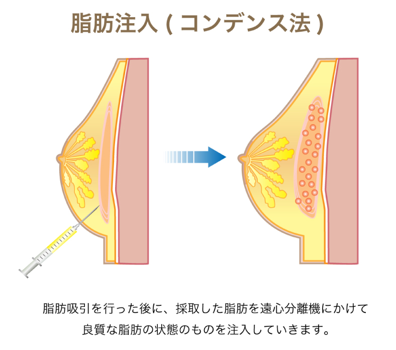 コンデンス法の図解