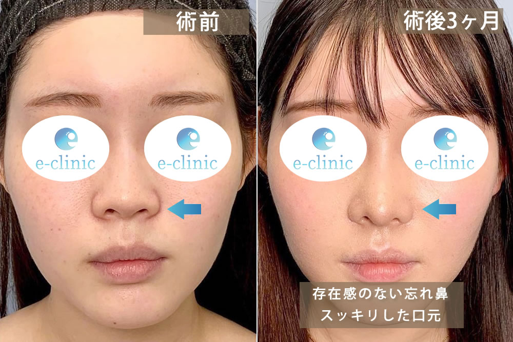 鼻中隔延長と軟骨移植と鼻尖形成の併用の正面の症例写真