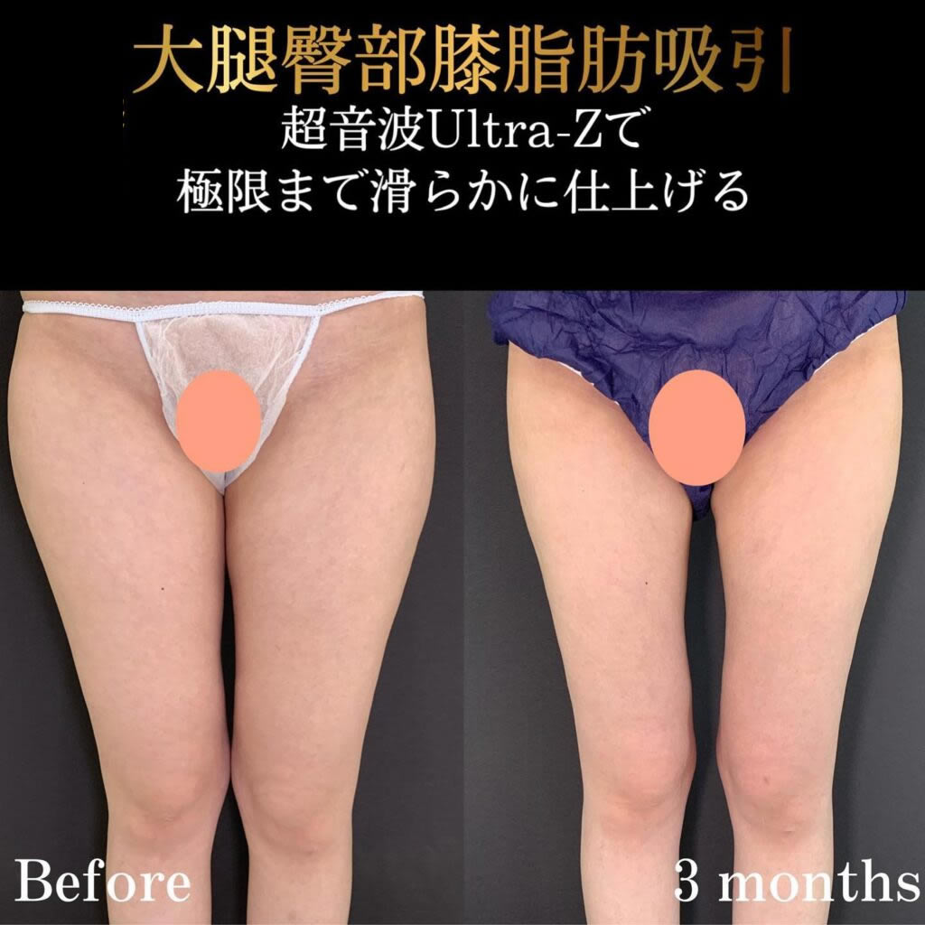 太ももの脂肪吸引の症例写真