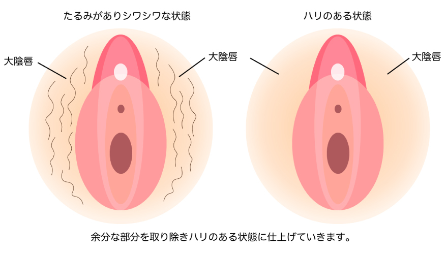 大陰唇たるみ取り縫いを説明する画像