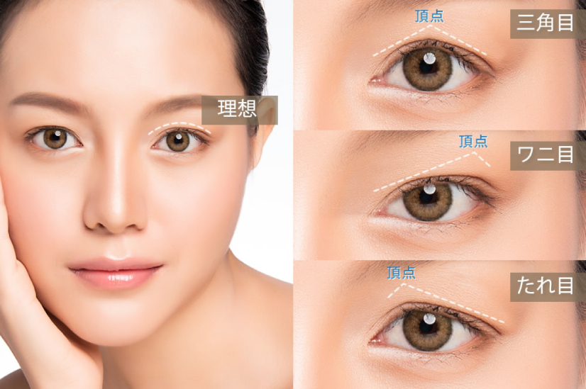 眼瞼下垂の失敗例の紹介の画像