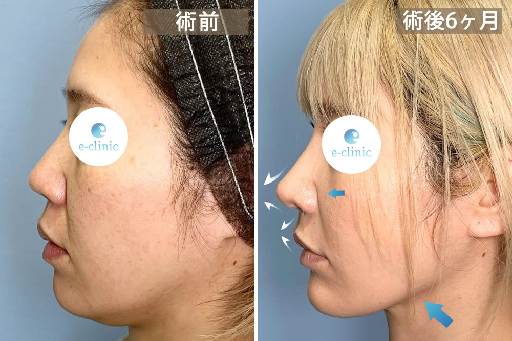 鼻整形と脂肪吸引を併用した横向きの症例写真