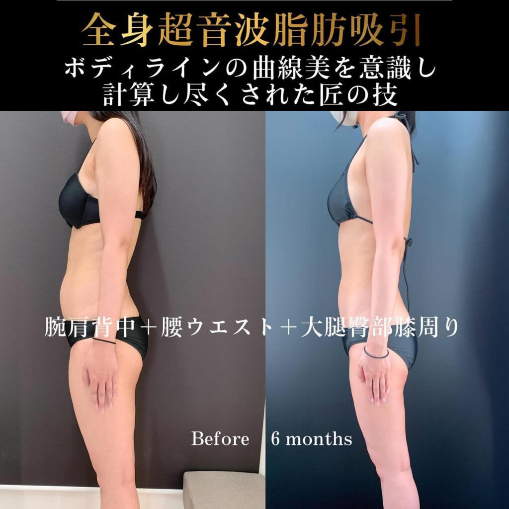 腰、ウエストの症例写真
