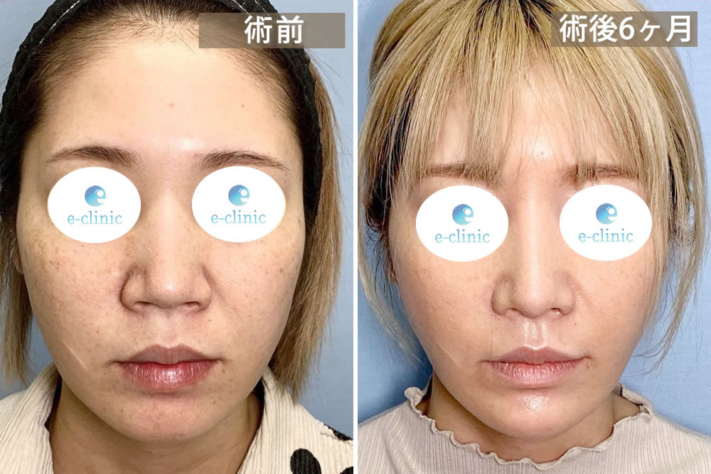 鼻整形と脂肪吸引を併用の正面の症例写真