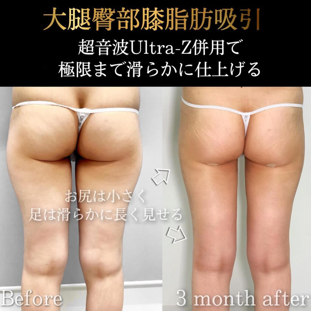 お尻の脂肪吸引の症例写真