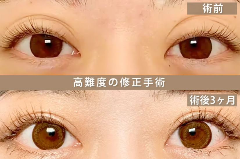 二重のラインを縫合している写真