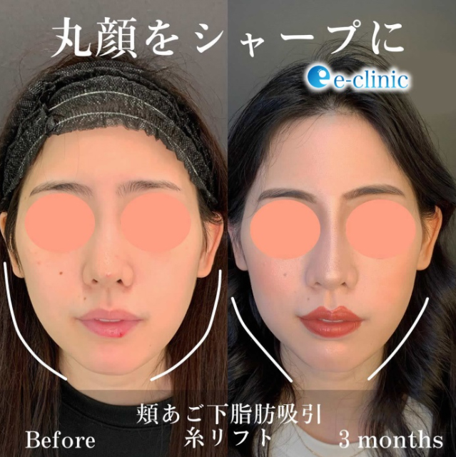 顔の脂肪吸引の症例写真
