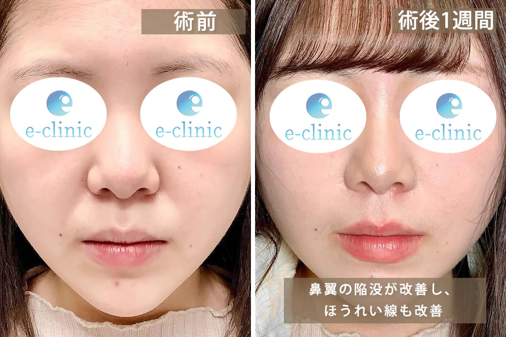 貴族手術の術前と1週間後の症例写真