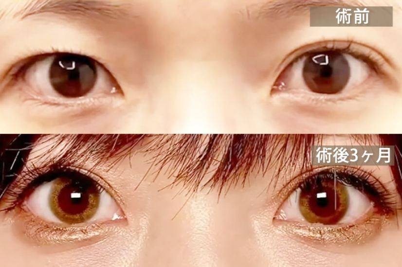 眼瞼下垂の症例写真