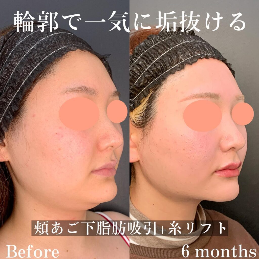 顎下の脂肪吸引の症例写真