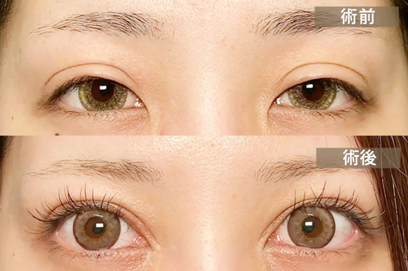 ハム目にならないように眼瞼下垂の手術をした症例写真