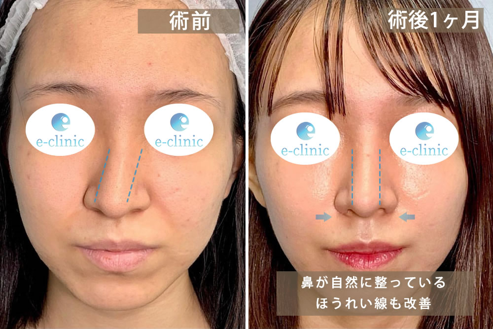 人工真皮を使用した貴族手術術の正面の症例写真