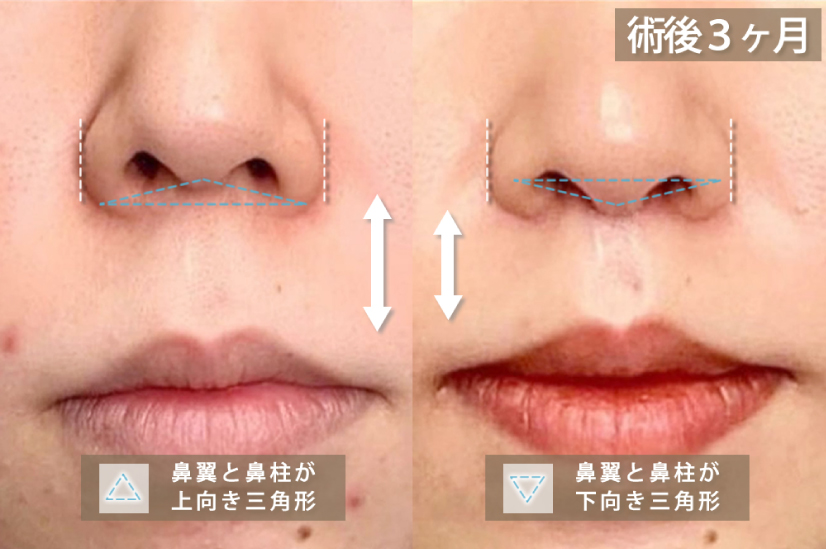 人中短縮術と鼻翼挙上術を併用した症例