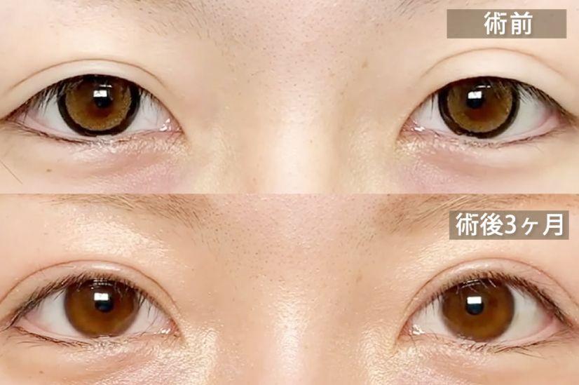 まつ毛の生え際が見える自然な二重整形の症例写真