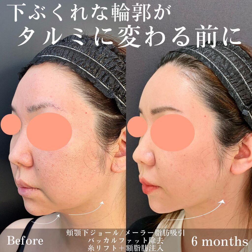 顎下の脂肪吸引の症例写真