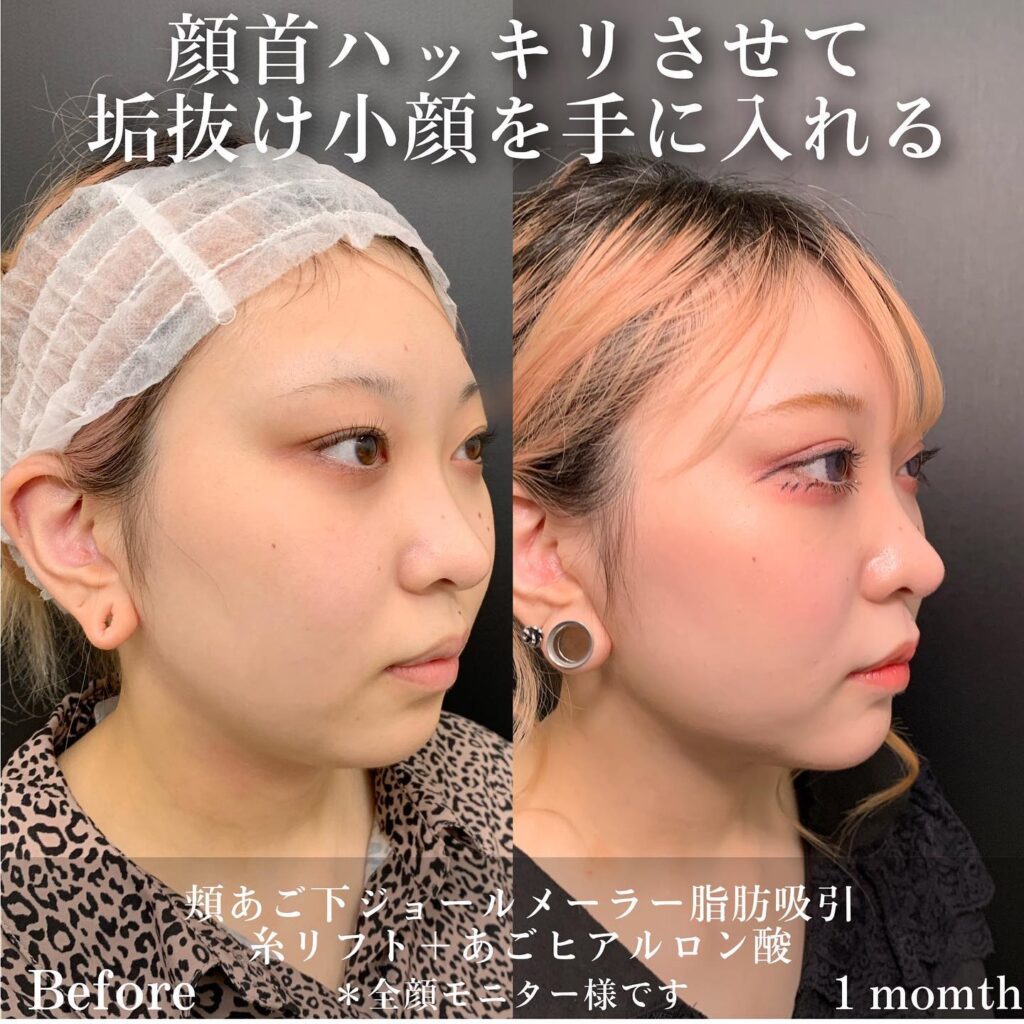ジョールファットと顔の脂肪吸引の症例写真