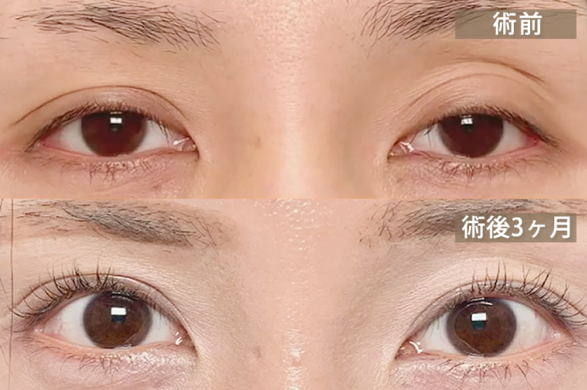 上瞼の眼窩脂肪の移動術の症例写真