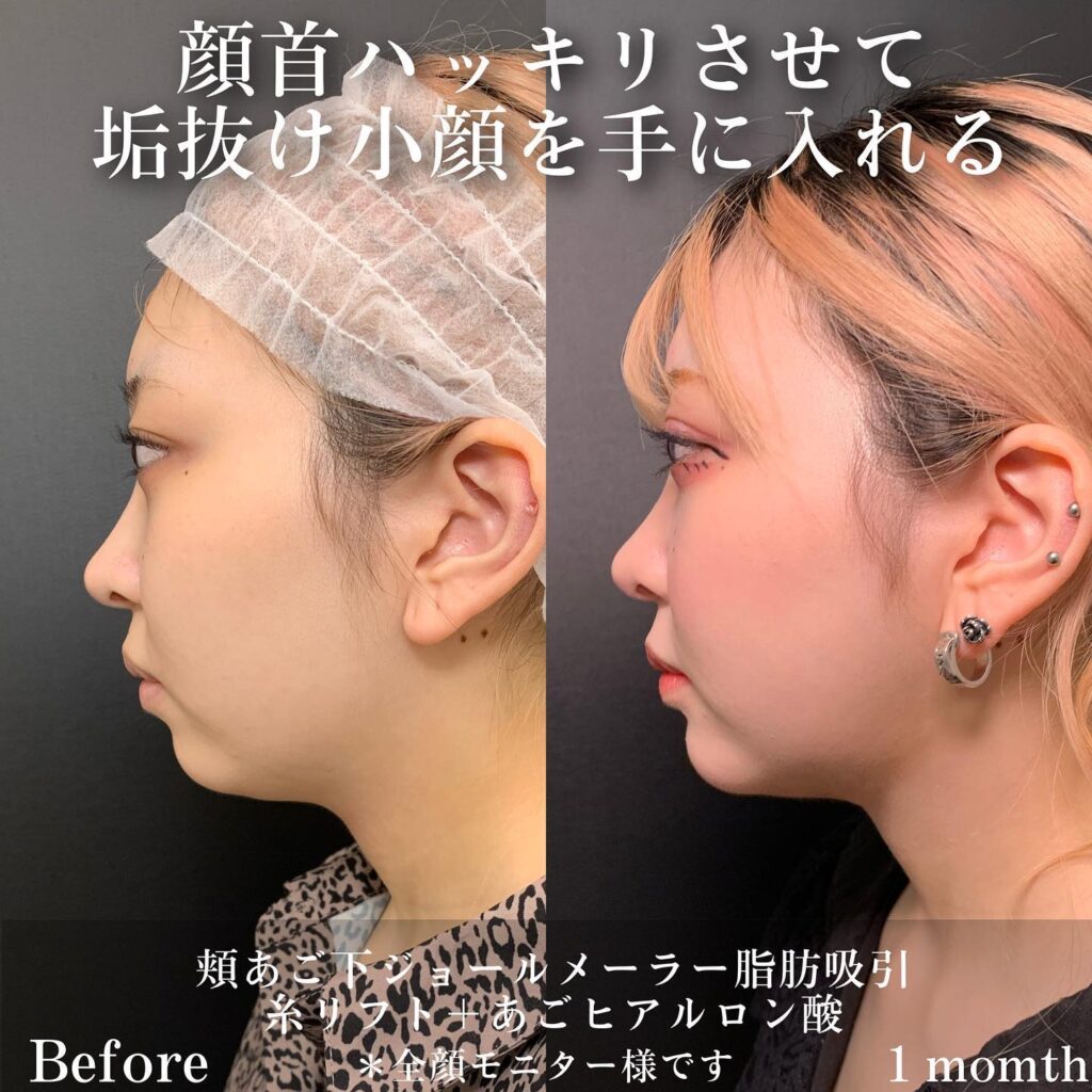 ジョールファットと顔の脂肪吸引の症例写真