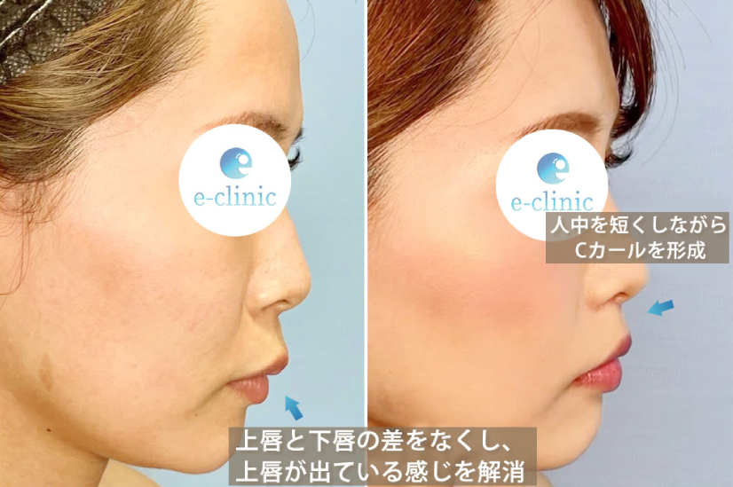 人中短縮の症例写真