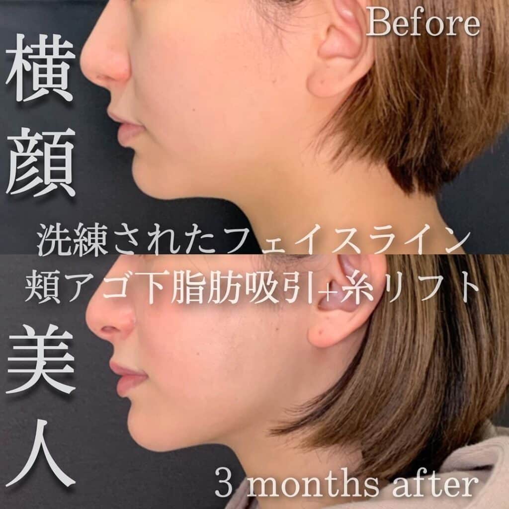 顔の脂肪吸引の症例画像