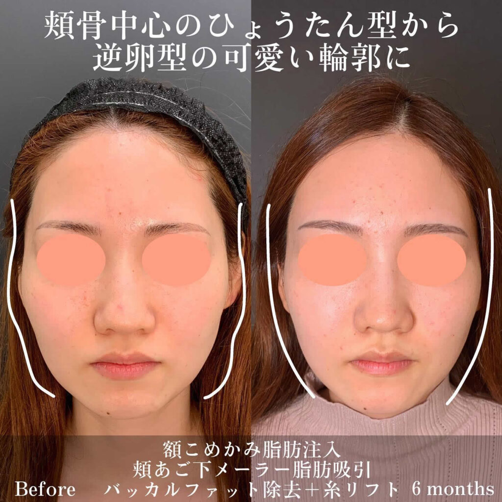 バッカルファットと小顔脂肪吸引の症例写真