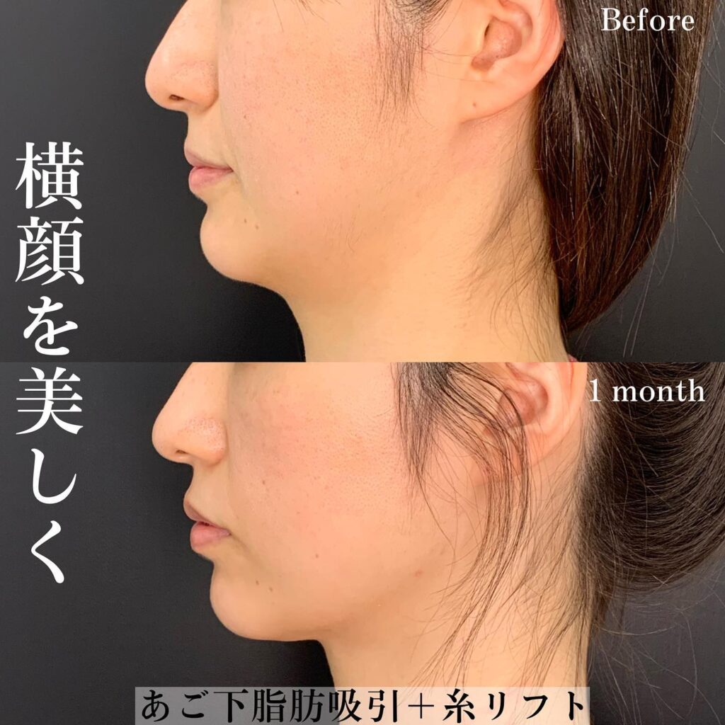 顔の脂肪吸引術後画像