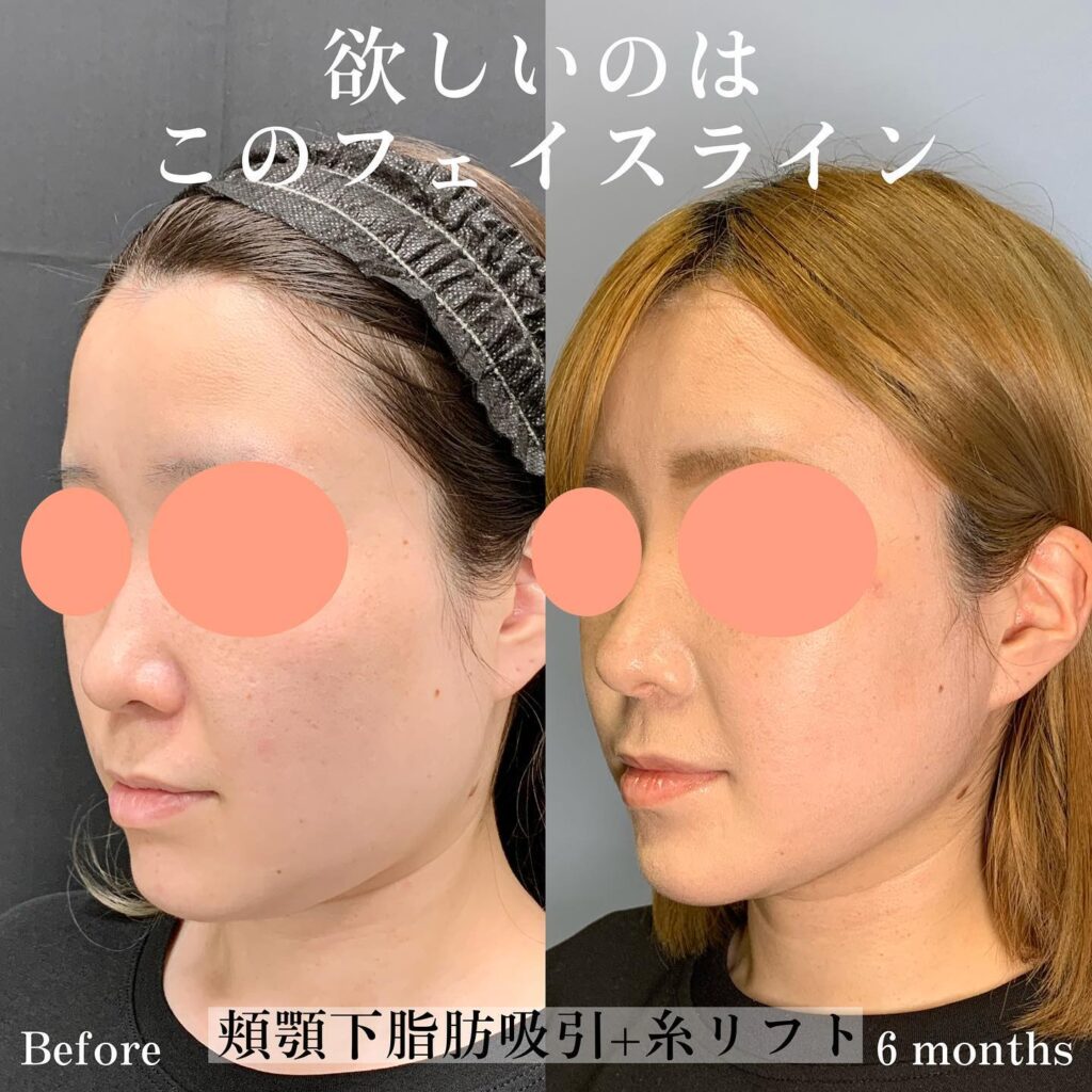 顎下の脂肪注入と糸リフトの症例写真
