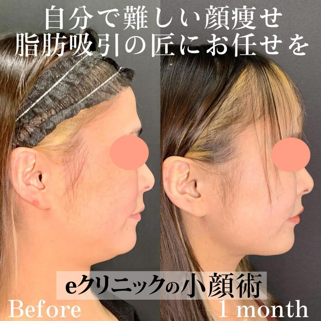 小顔脂肪吸引の症例写真