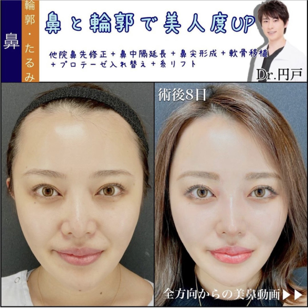 他院の鼻先修正と鼻中隔延長と鼻尖形成と軟骨移植とプロテーゼの入れ替えと糸リフトの症例写真