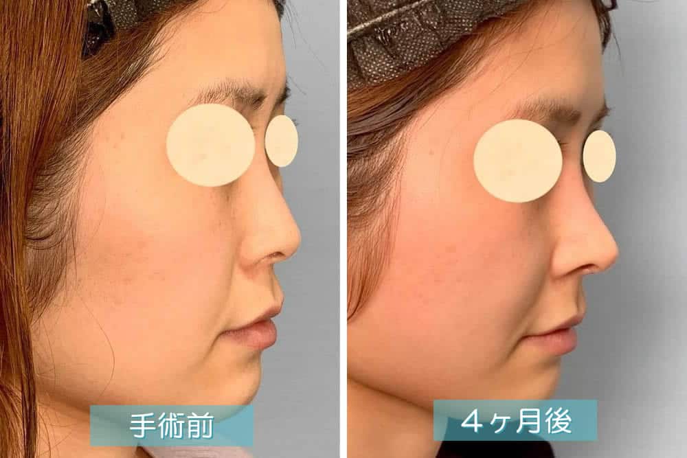 プロテーゼ術後の症例写真