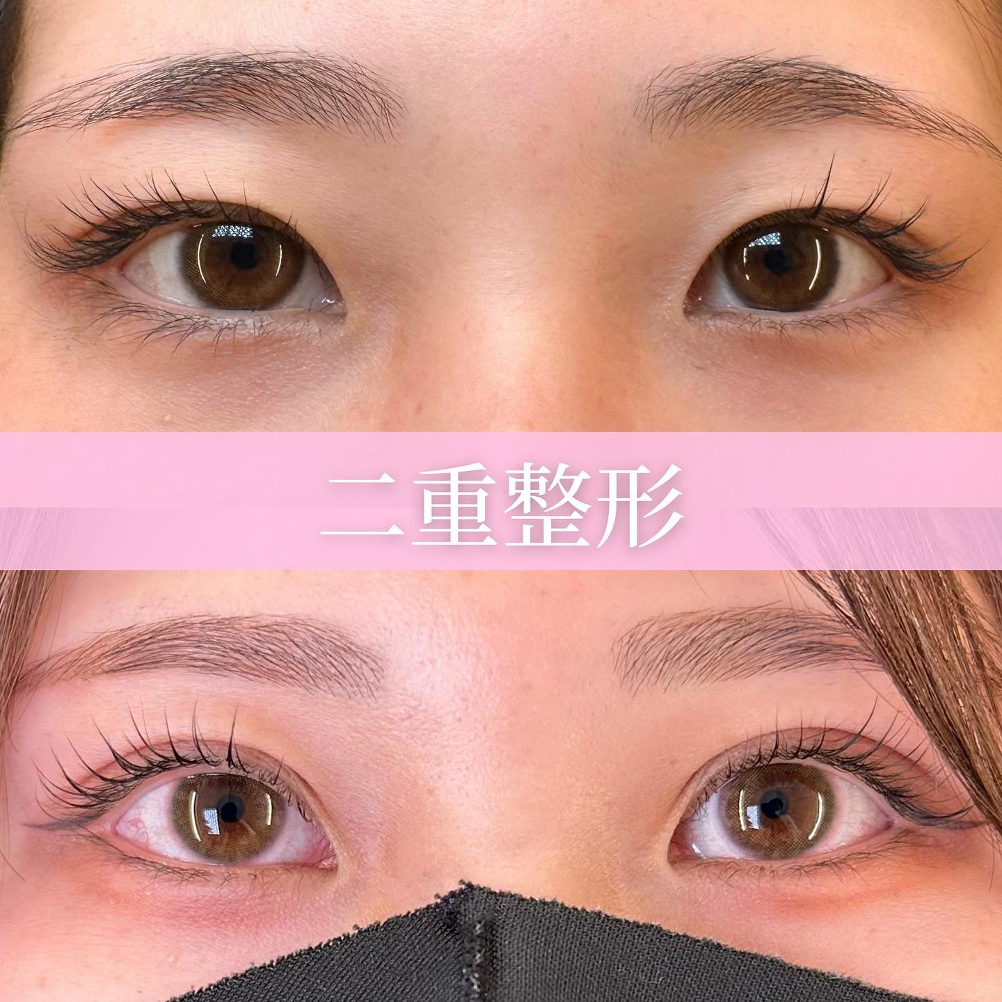 埋没法の術前と1か月後の症例写真