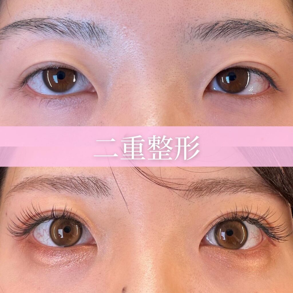 埋没法の術前と1か月後の症例写真