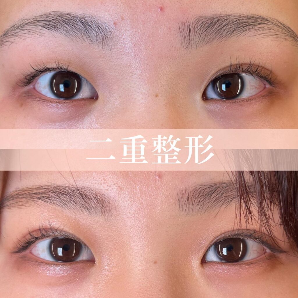 埋没法の術前と1週間後の症例写真